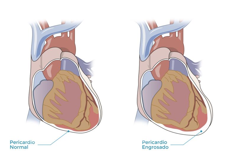 pericarditis-cirugia-corazon