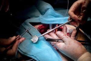 Prótesis cardiaca